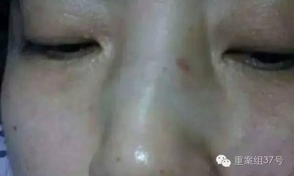 媒体报道遭女患者殴打致鼻骨骨折的医生，网曝打人者系申请在上海落户的缪某。 图片来源：东方早报官方微博